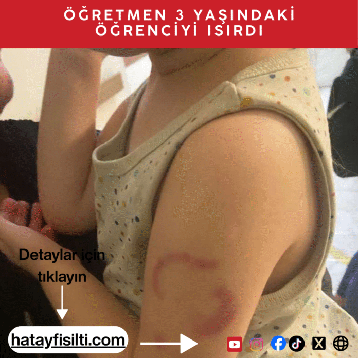 Edirne’de özel bir kreşte, 3 yaşındaki öğrenciyi uyandırmak için ısırdığı iddia edilen öğretmenin görevine son verildi. Öğretmen, savunmasında “Isırmadım, öperken oldu” dedi.